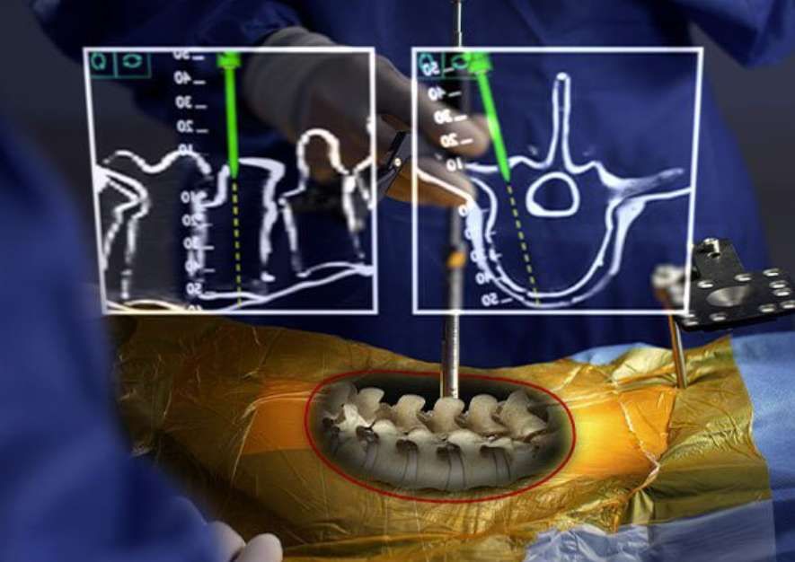 Augmedics AR脊柱導航系統突破10000例手術治療